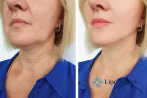 Double chin before and after Hi-Fu treatment 4 Book your double chin treatment Edgbaston today! We are here to help!