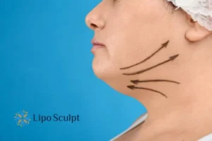 Double chin before and after Hi-Fu treatment 3 Boost your confidence with a Double chin treatment Edgbaston