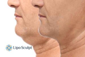 Double chin before and after Hi-Fu treatment 2 Double chin treatment Edgbaston from Lipo Sculpt - feel more confident today!