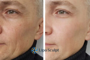 How to Fight Aging Symptoms 3 Fight Aging Symptoms Edgbaston With HIFU and Morpheus8 Today!