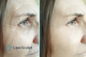 How to Fight Aging Symptoms 2 Do you want to Fight Aging Symptoms Edgbaston? Contact Lipo Sculpt today!