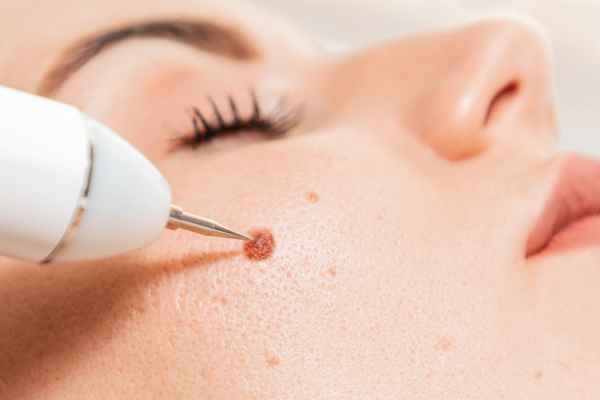 CryoPen: 5 Skin Concerns It May Be Used to Treat 3 What actually happens during a CryoPen treatment Edgbaston?