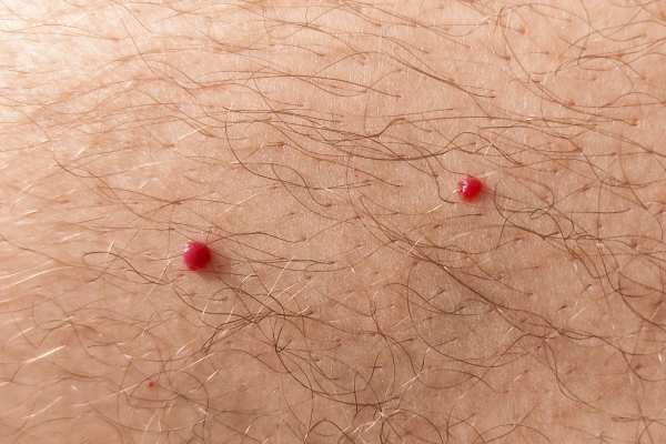 CryoPen: 5 Skin Concerns It May Be Used to Treat 2 cherry angioma removal Edgbaston