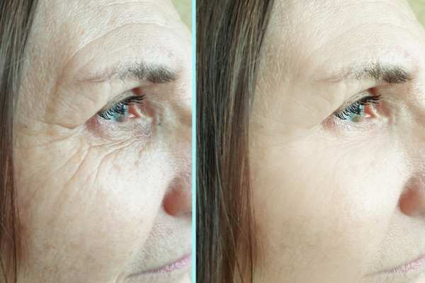 Why Do People Choose HIFU for a Non-Surgical Facelift? 4 How long can HIFU results last Edgbaston?