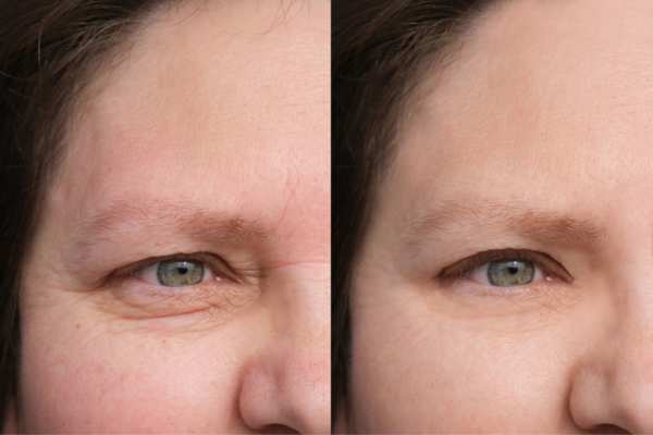 HIFU vs Botulinum Toxin: Understanding the Differences 4 How long do HIFU results last Edgbaston?