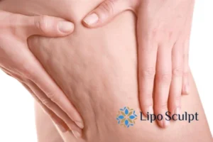 CoolSculpting for Legs: The Innovative Approach to Redefining Your Legs 5 Start your journey today book your coolsculpting treatment Edgbaston online today!