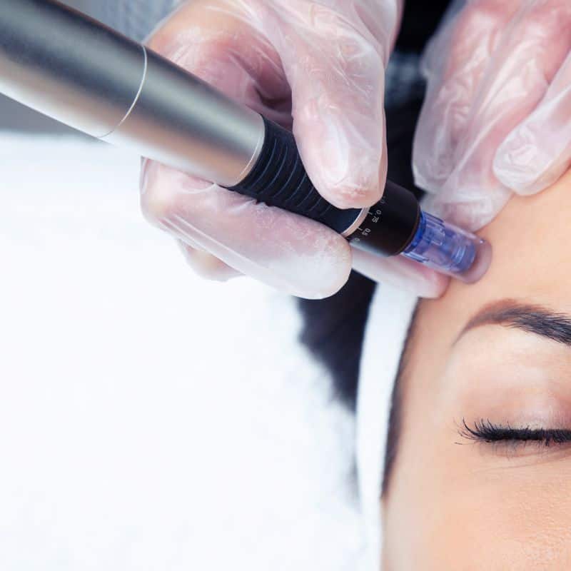 Morpheus8 treatment Edgbaston from Lipo Sculpt - Book in today!