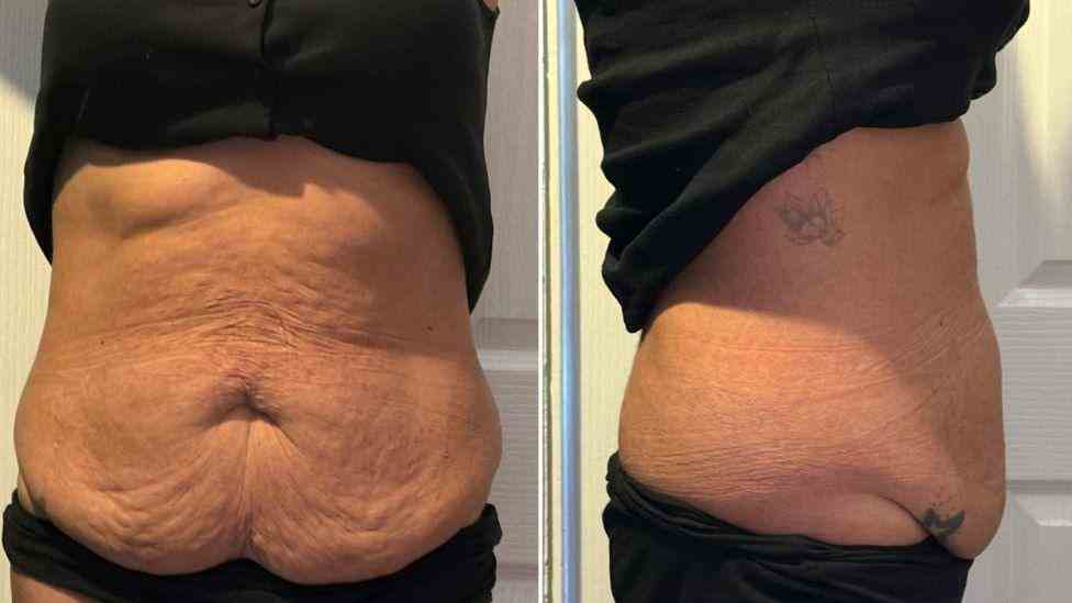 Lost the Weight but Not the Loose Skin? What You Should Know 1 Is It Definitely Loose Skin Edgbaston?